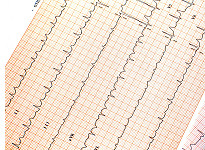 EKG Heart Chart